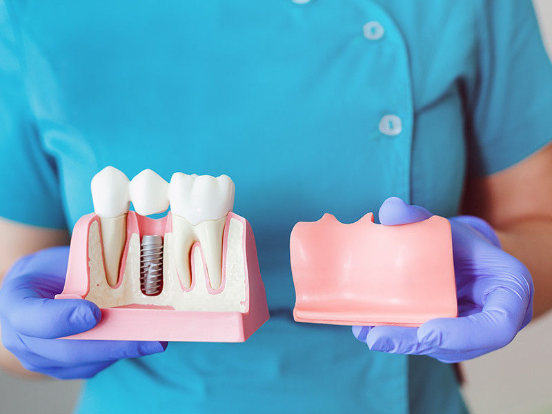 Cum și când se poate pierde un implant dentar?